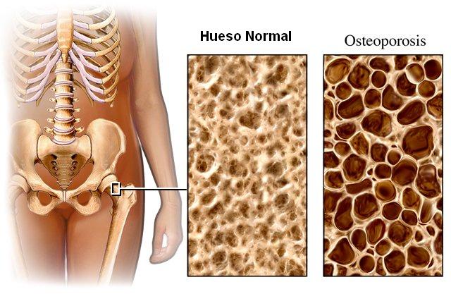 Tecnologia para tratar el cáncer: Cáncer de Hueso