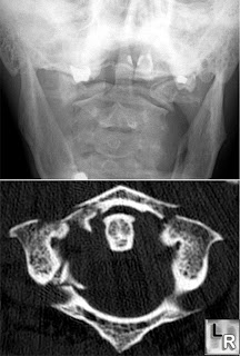 jefferson fracture