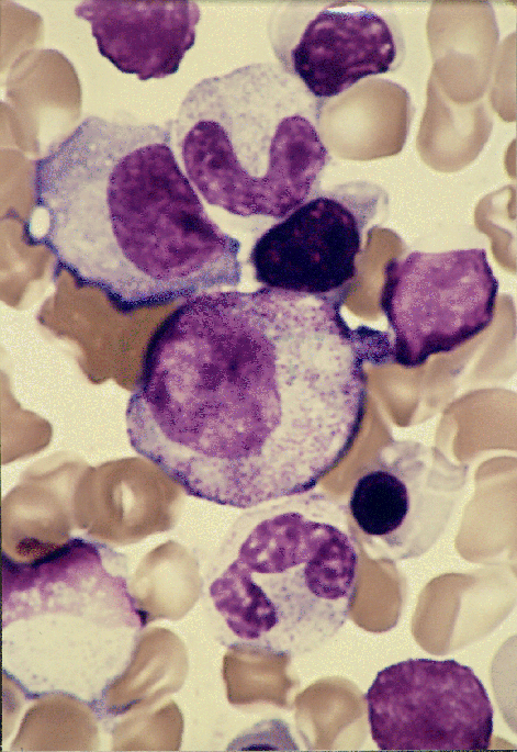[Leukemiapic.gif]