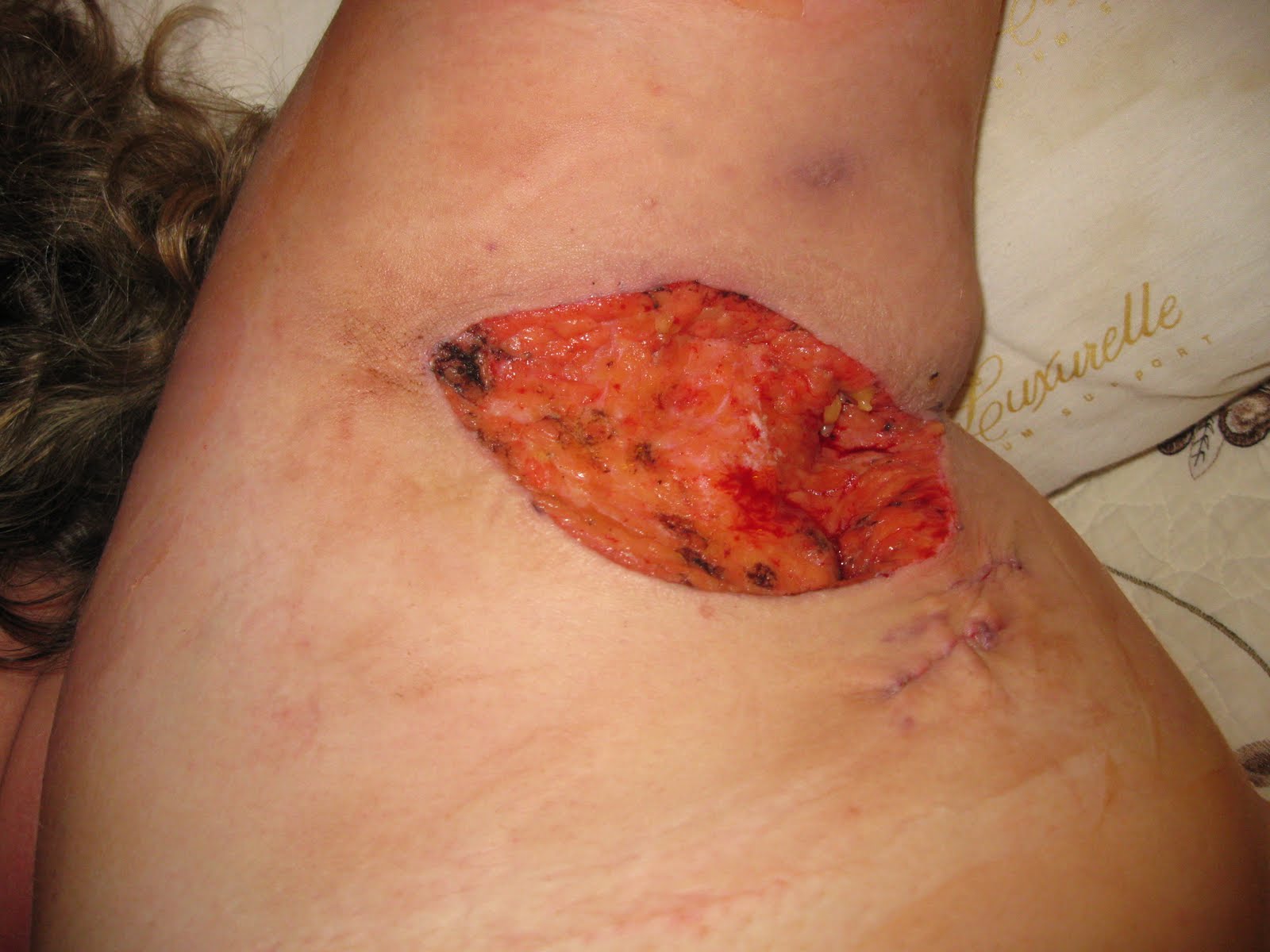 My HS experience The first day after surgery, after wound