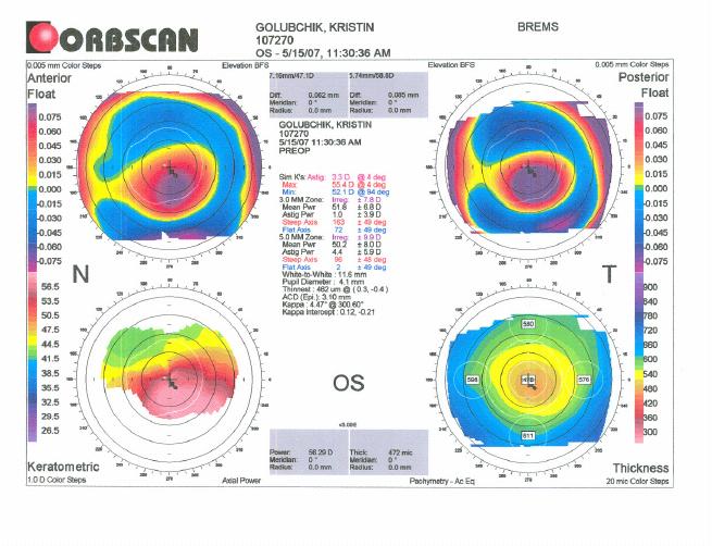 кератоконус топограф. кератоконус кератотопограмма. кератоконус топография. кератоконус топография роговицы. кератоконус кератотопограмма.