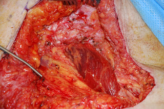 Flap Surgery: Autologous Tissue, Wounds, Microvascular Free Flaps