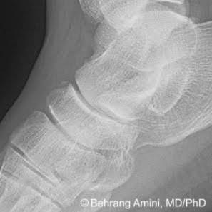 Roentgen Ray Reader: Avulsion Fractures of the Tarsal ...