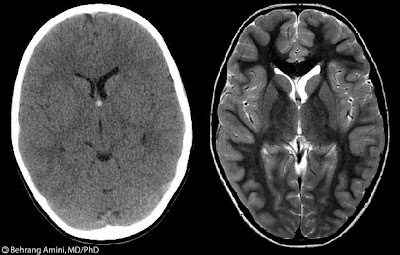 Roentgen Ray Reader: Colloid Cyst