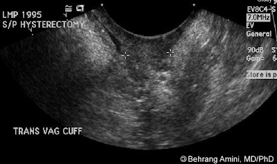 Roentgen Ray Reader: Normal Appearance of the Vaginal Cuff on Ultrasound
