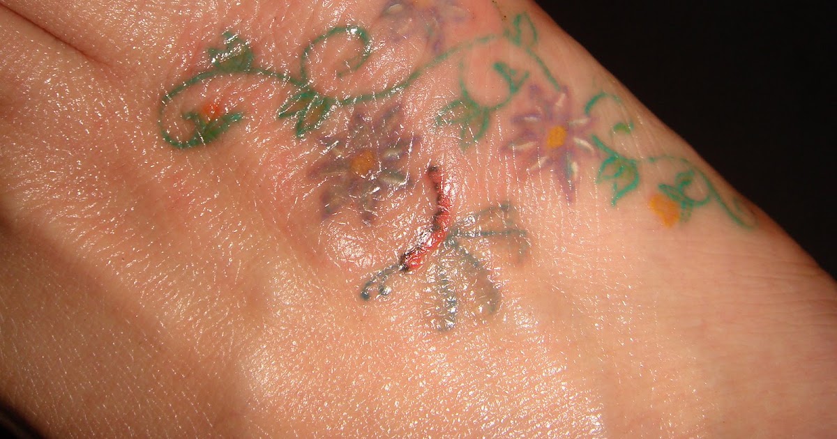 Tattoo Removal Using TCA Pictures of TCA Reactions and