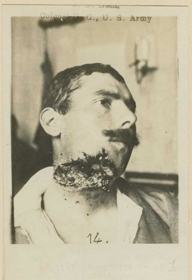 Skin crepitation Beautiful Gallery World