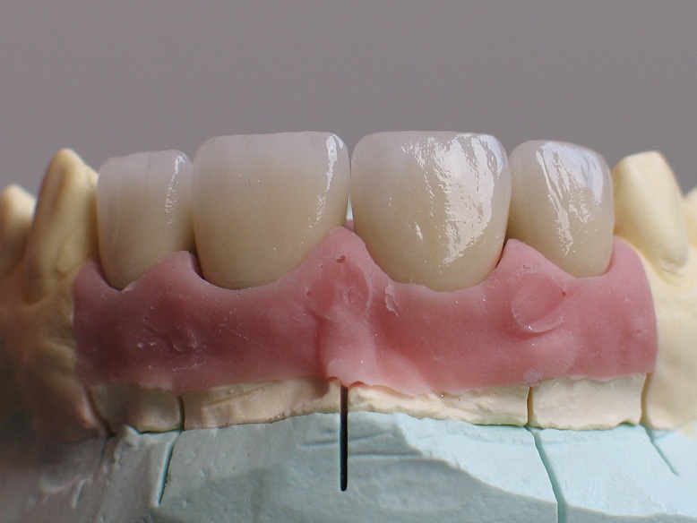 Vita VM13 Laboratorio Dental Alvadent