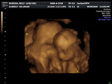 Twins 3D at 21 weeks