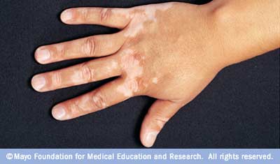 [vitiligo.jpg]