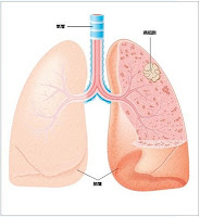 肺葉癌細胞