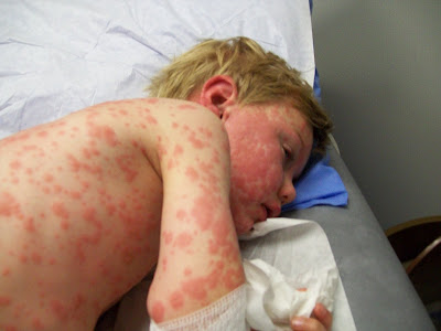 Hardin MD : Neonatal Herpes Pictures