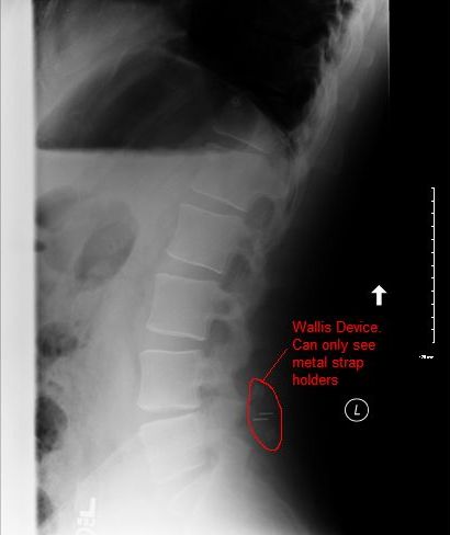 [X-Ray_After.jpg]
