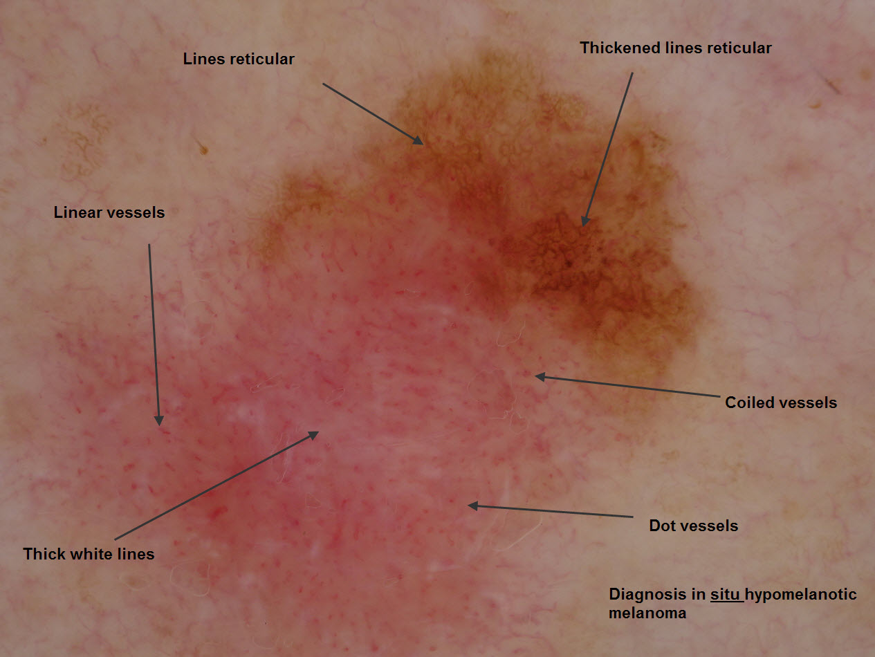 Amelanotic Melanoma - Pictures, Symptoms, Prognosis ...