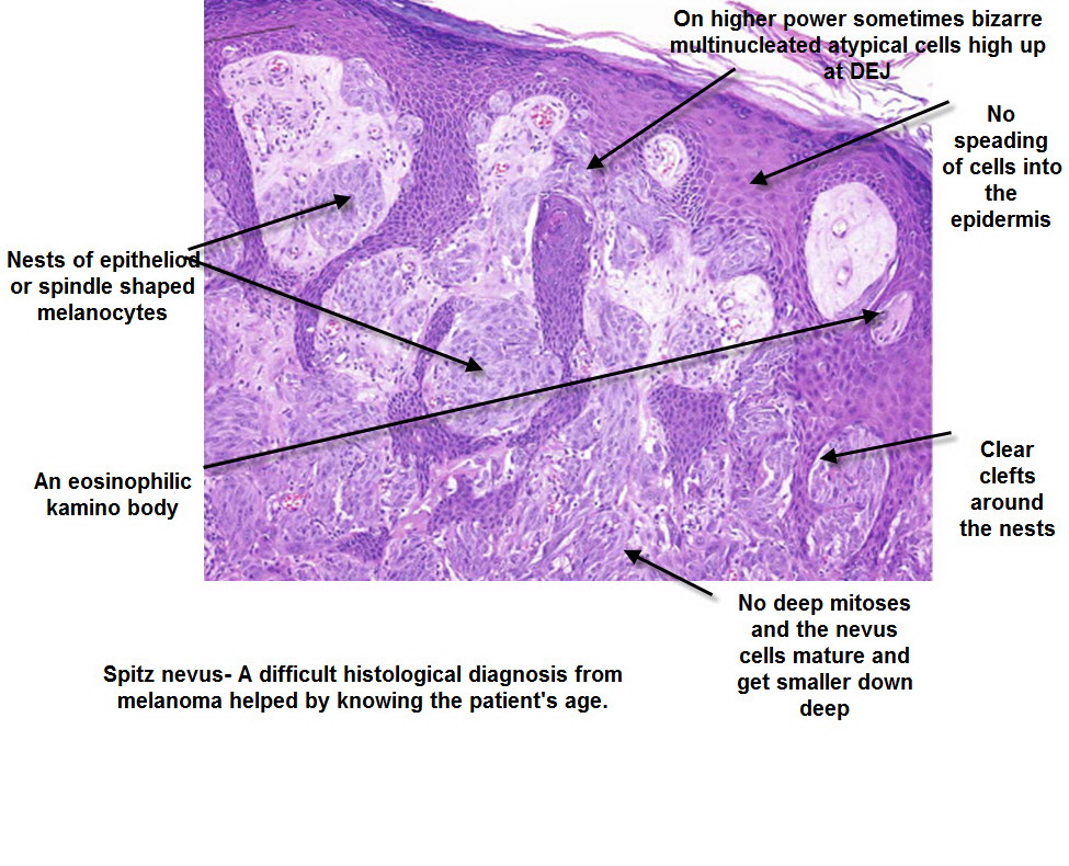 Dermoscopy made simple spitz nevus