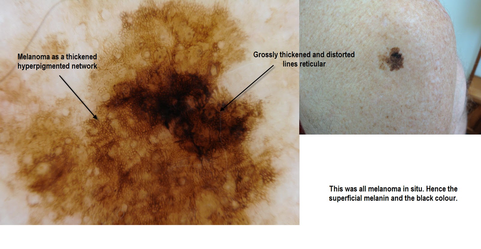 Dermoscopy Made Simple Melanoma in situ mainly
