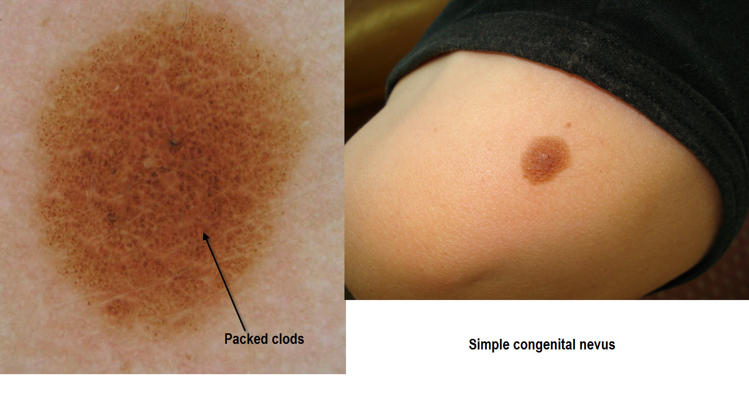 Dermoscopy Made Simple Congenital Nevus