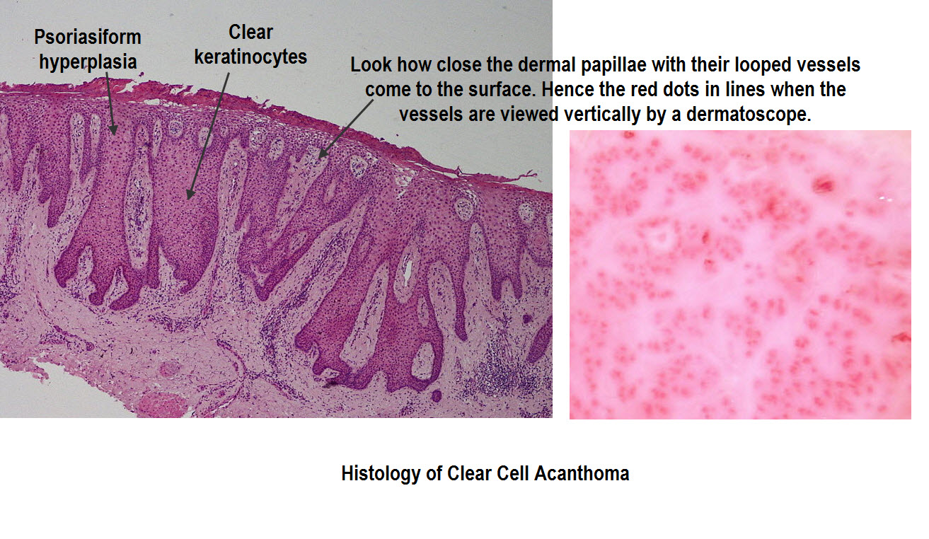 Clear cell acanthoma - Wikipedia