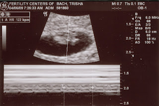 The Creech Twins: 7 week 1 day Ultrasound Photos