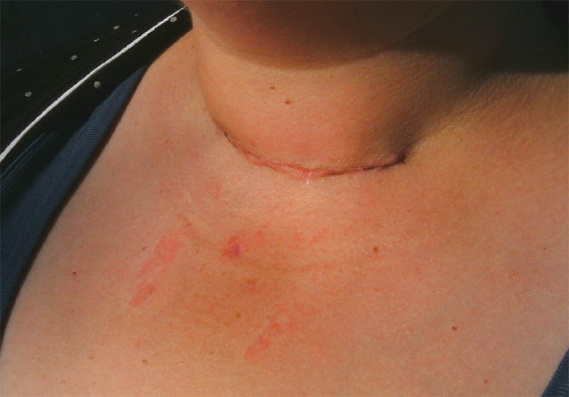 My Thyroid Journey Scar Progress Pics