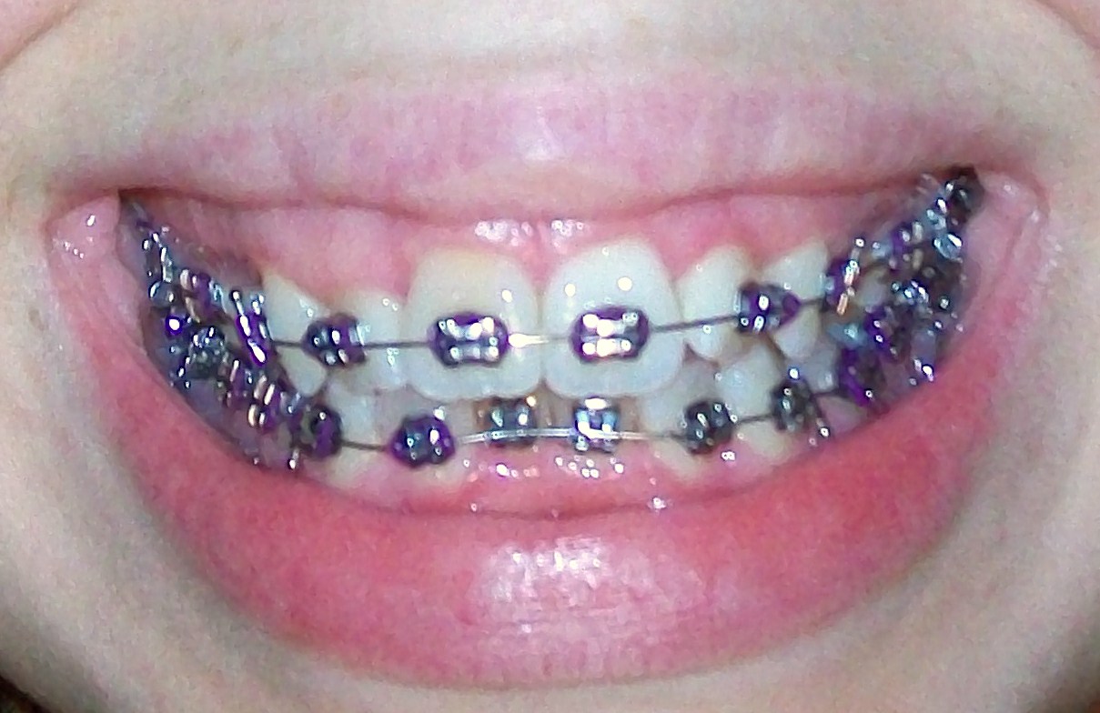 Braces at twenty My First Braces Tightening