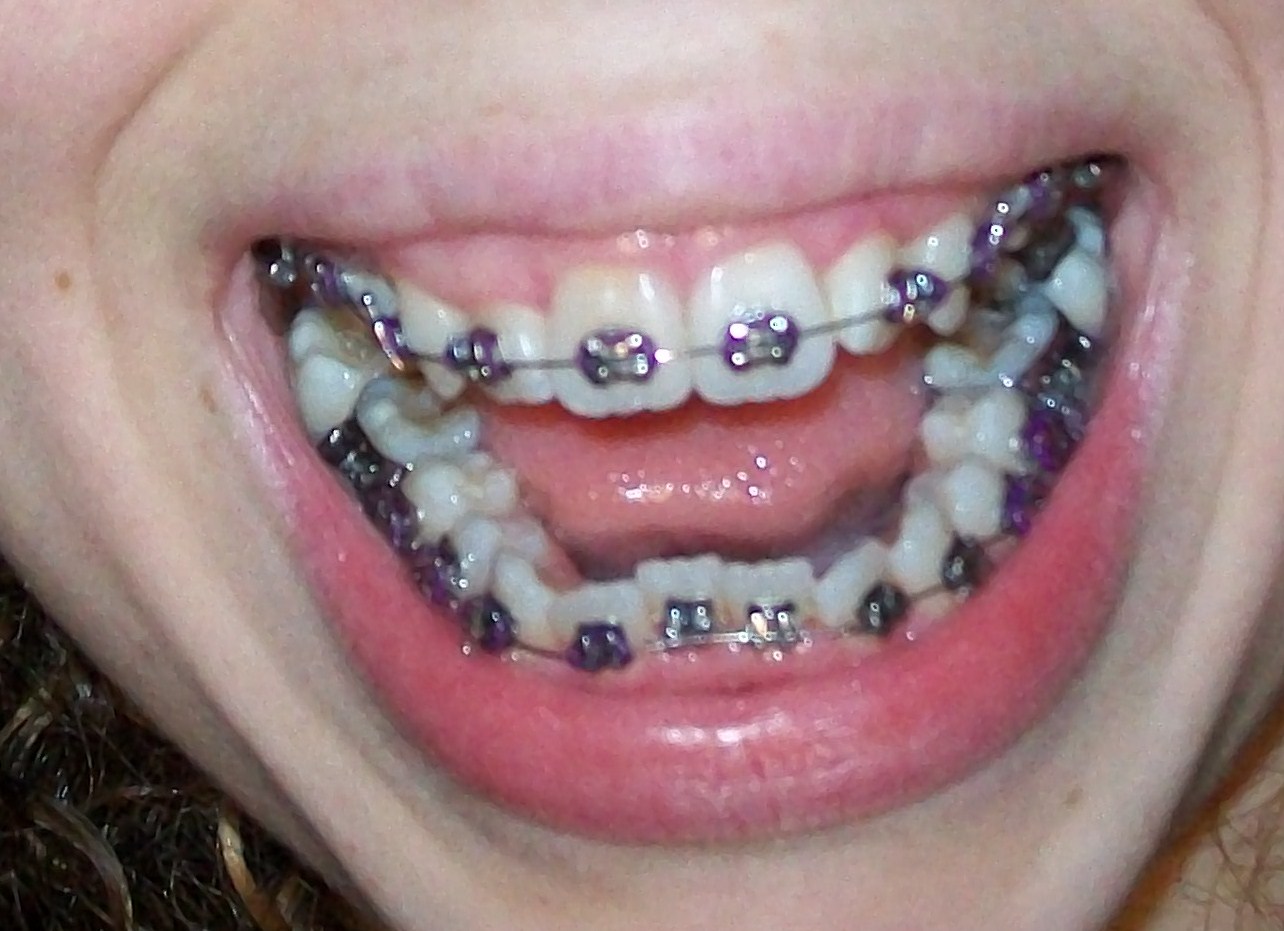 Braces at twenty My First Braces Tightening