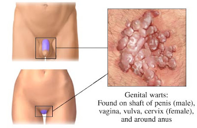 genital_warts_location