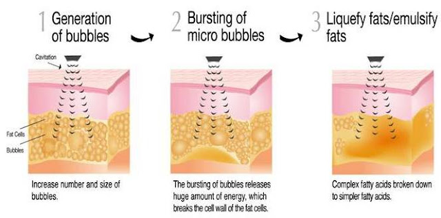 Cavitation Latest Technology in Slimming