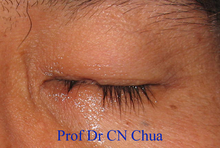 Eyelid Surgery by Prof Dr CN CHUA 蔡鐘能: My Eye Surgeon Did That to My ...