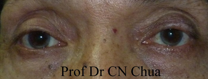 Eyelid Surgery by Prof Dr CN CHUA 蔡鐘能: How I Removed a Benign Lesion ...