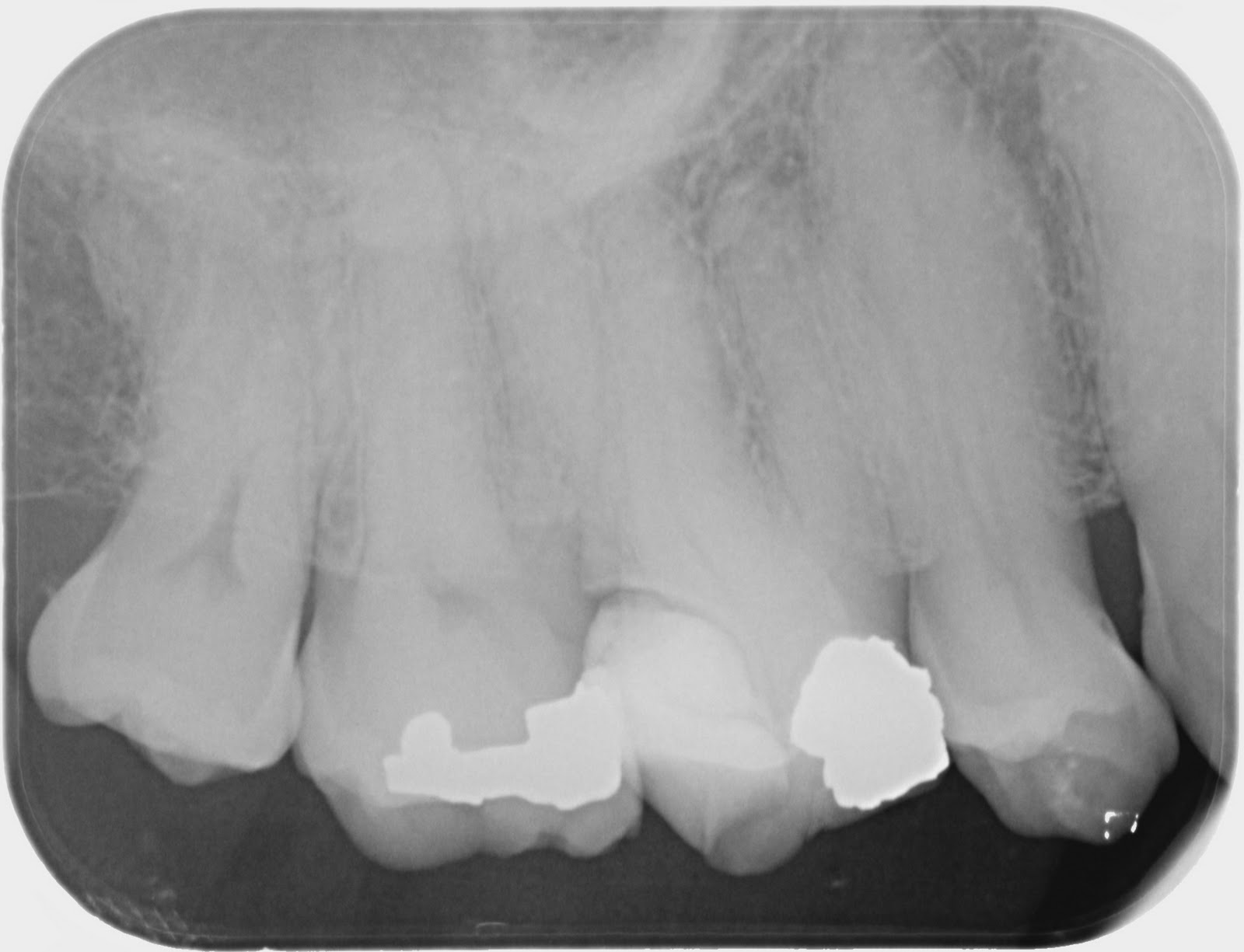 madtooth Calcified canals.