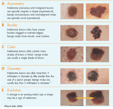 D Day Minus: About Melanoma in Young Adults