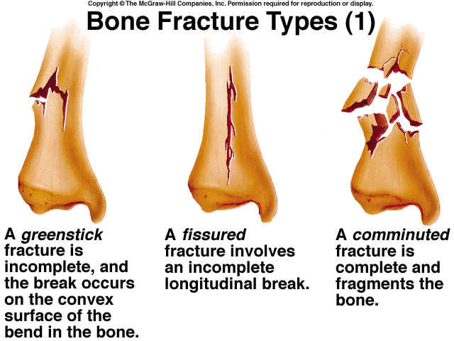 Anatomy2hour: Bone Fractures