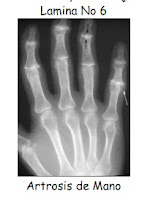 artrosis mano, sx articulaciones
