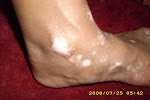 Ankle spots