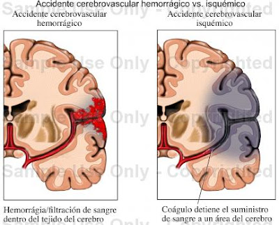 Hipertensión arterial sangrado de la Hipertensión arterial sangrado de la