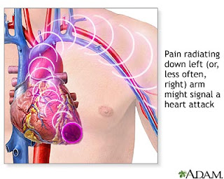 heart-attack-symptoms-angina