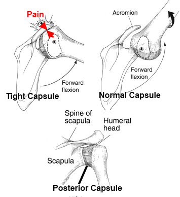 https://4.bp.blogspot.com/_7o9rCA8Mqao/TJ-7pAjUS6I/AAAAAAAAA8U/hRQEBG0X6fU/s1600/Posterior_Capsule_Tightness_in_shoulder_pain.png?utm_source=chatgpt.com