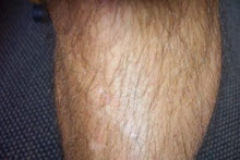 lower leg hair