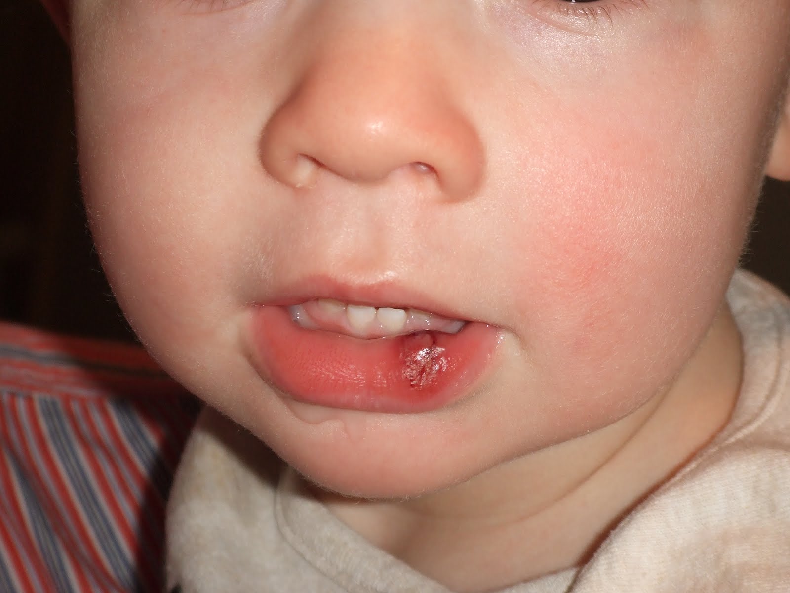 maxwell-abraham-asher-neal-max-s-first-busted-lip
