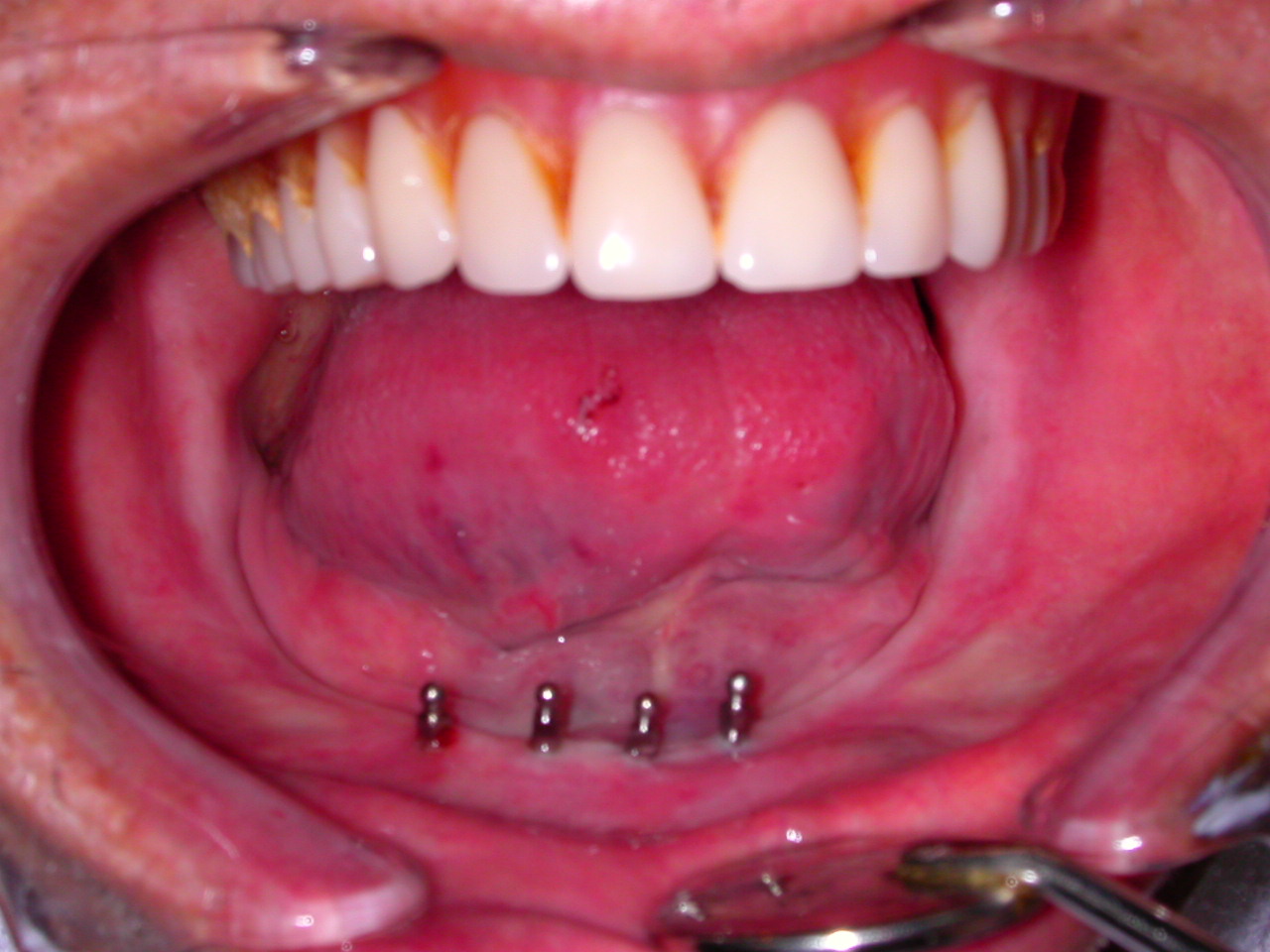 Dental Implantology: CASE OF FULL LOWER FALSE TEETH ...
