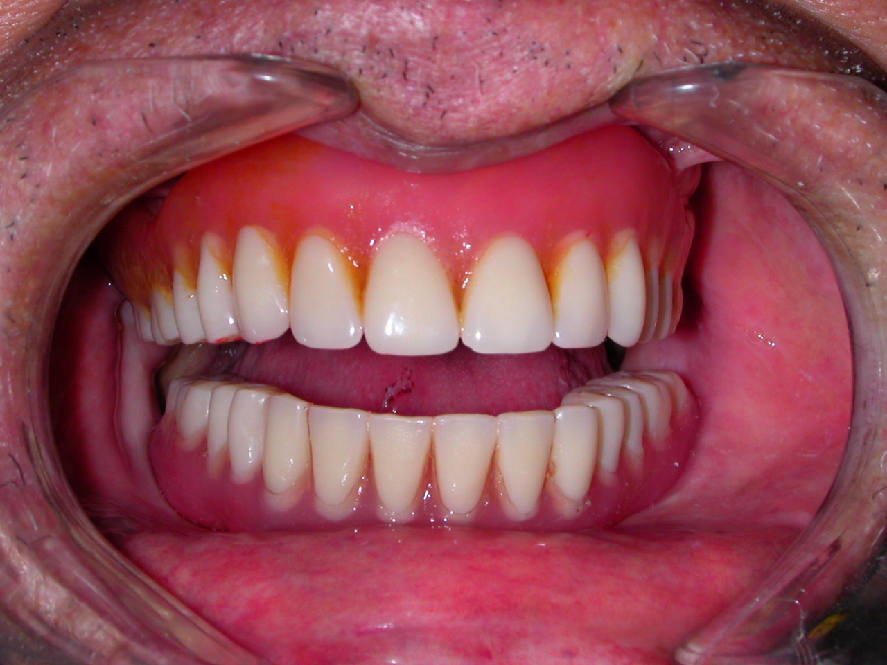 Dental Implantology CASE OF FULL LOWER FALSE TEETH STABILISED BY MINIIMPLANTS