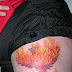 Courtesy laser technology-Easy way to remove tattoo