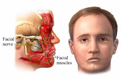 Paralisis Facial Periferica