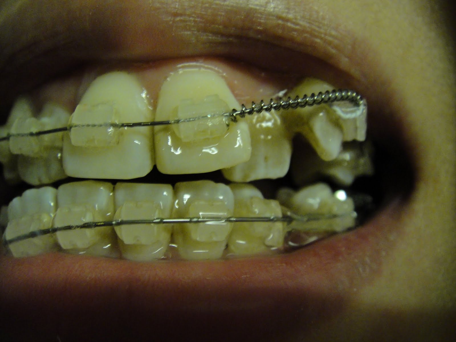 Sharon's Braces Diary