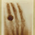 La mano de Bertha, la primera radiografía de la historia