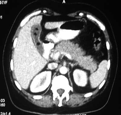 gallstones cholesterol radiodiagnosis imaging interesting cases amazing