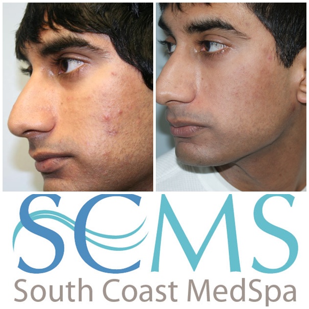 Los Angeles Laser Acne Scar Removal