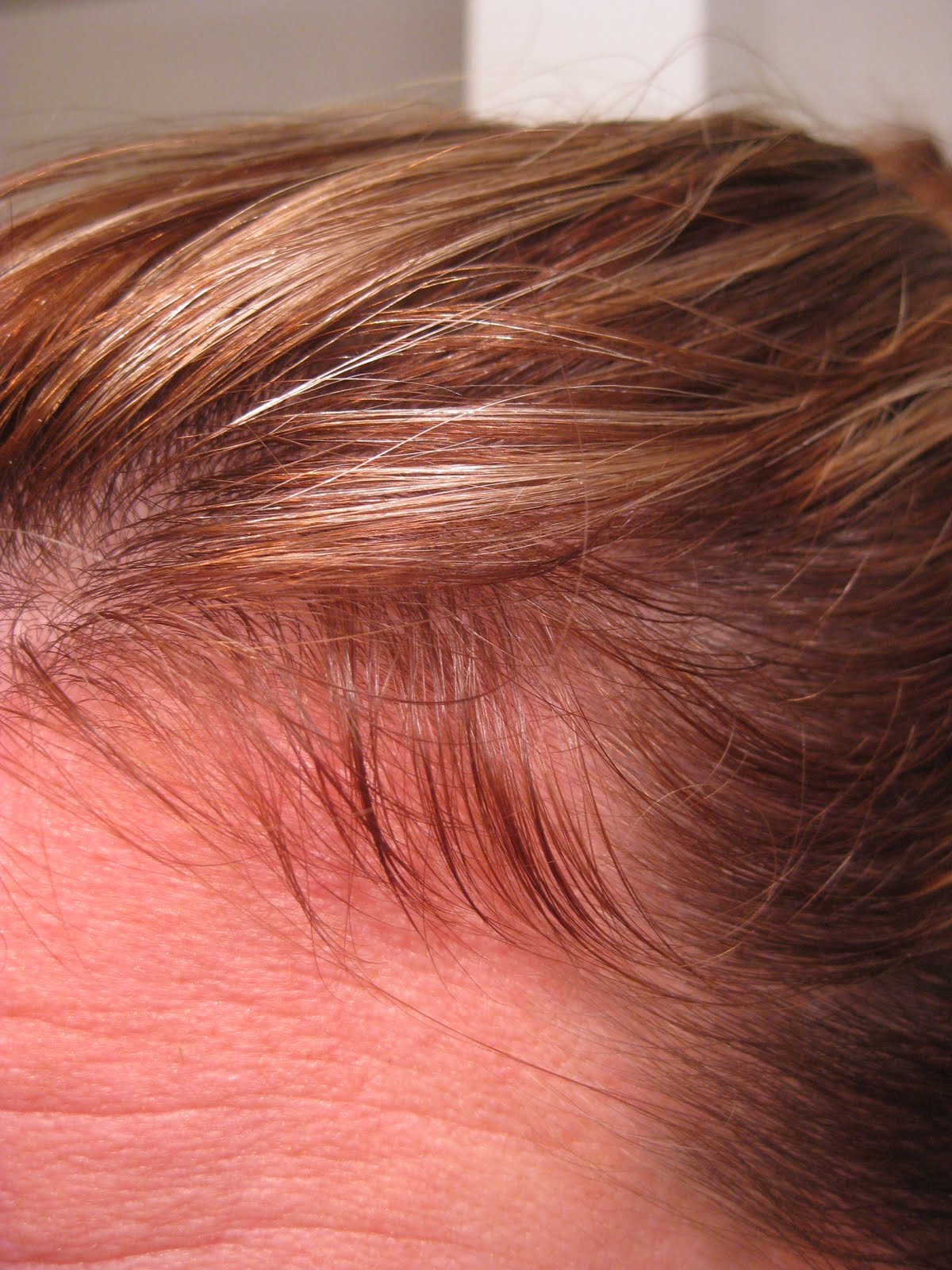 Pill S Place Bangs Well To Be Honest This Just Goes Show How Much Of A Receding Hairline I Was Developing Have On Both Sides And Then Thinner Regrowth All Around