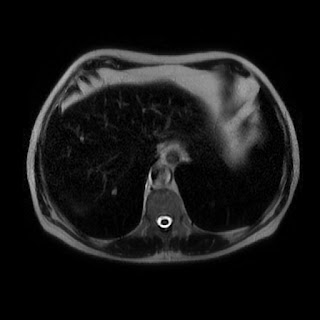 Radiology Cases: Haemochromatosis with presumed HCC